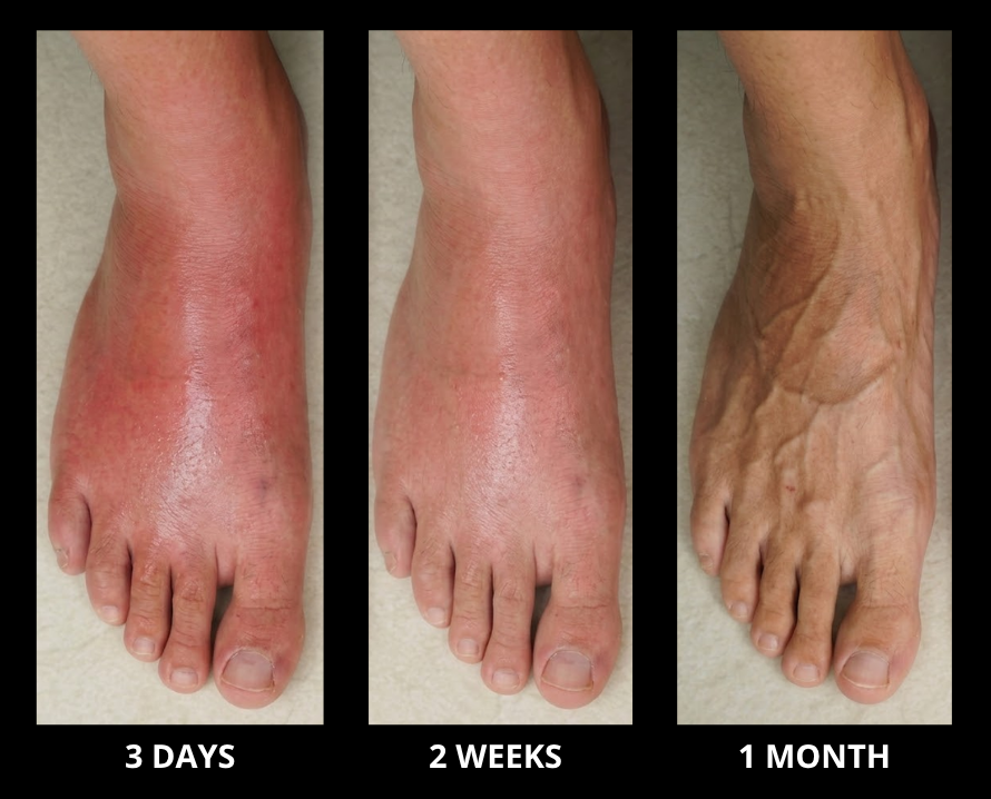 Nerve reset results: 3 days, 2 weeks, 1 month